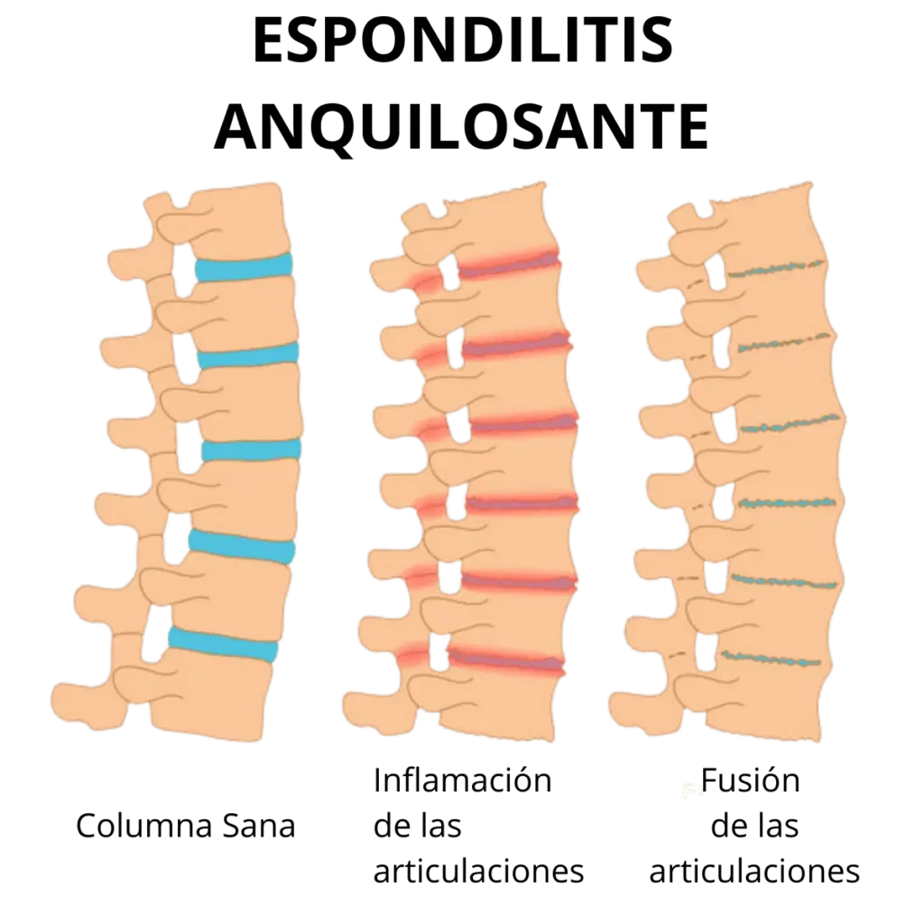 clinica_de_reumatologia_espondilitis_anquilosante