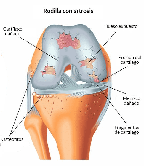 clinica_de_Reumatologia_artrosis