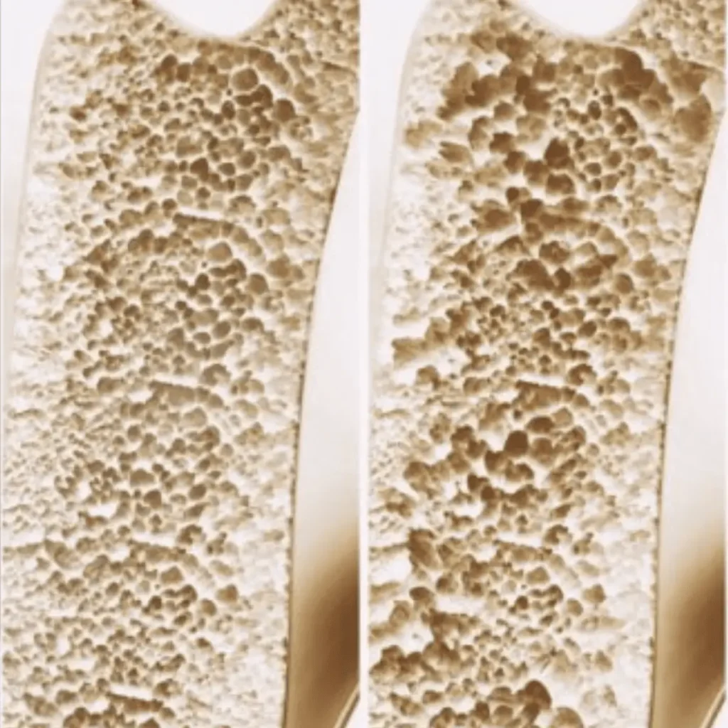 clinica_de_rreumatologia_osteoporosis