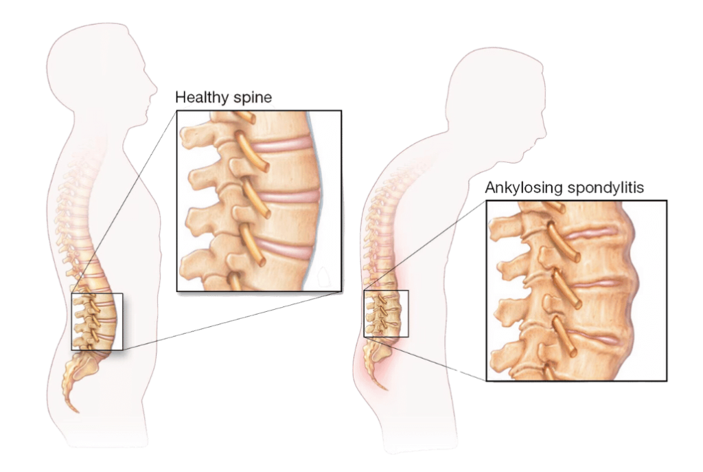 espondilitis-anquilosante-clinica-reumatologia