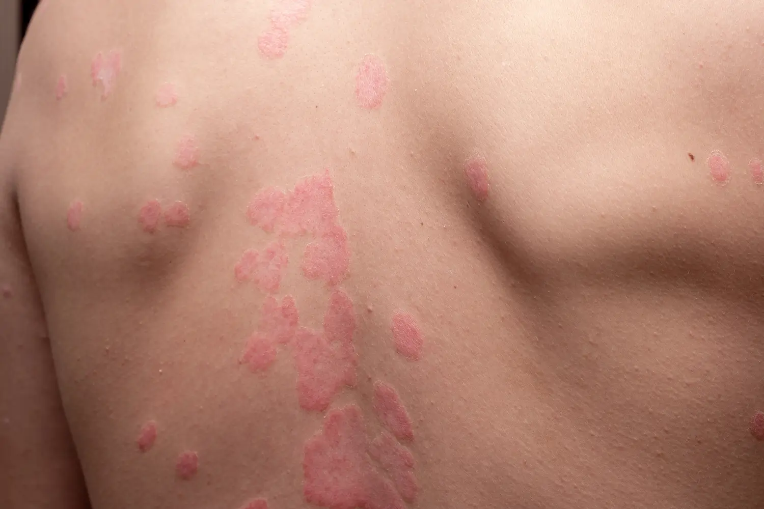Clínica de reumatología | que es lupus - clinica de reumatologia