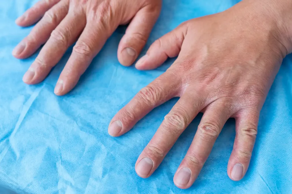 Imagen comparativa entre articulación sana y afectada por artritis psoriásica