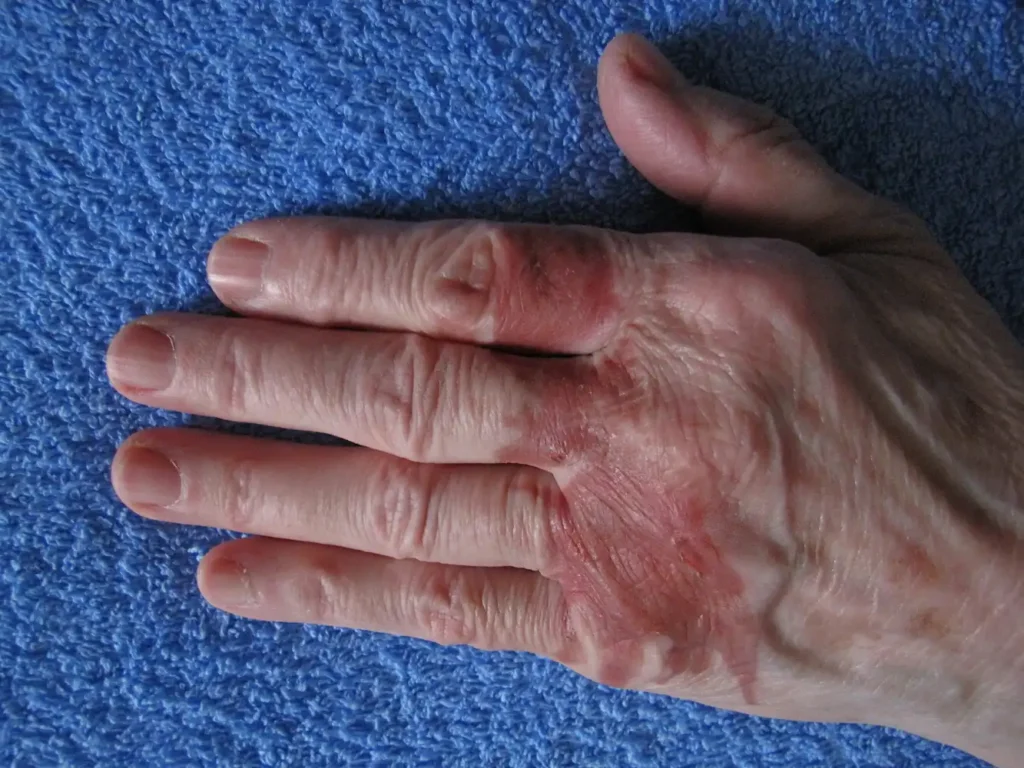 Clínica de reumatología | Imagen de articulaciones inflamadas en manos con artritis psoriásica