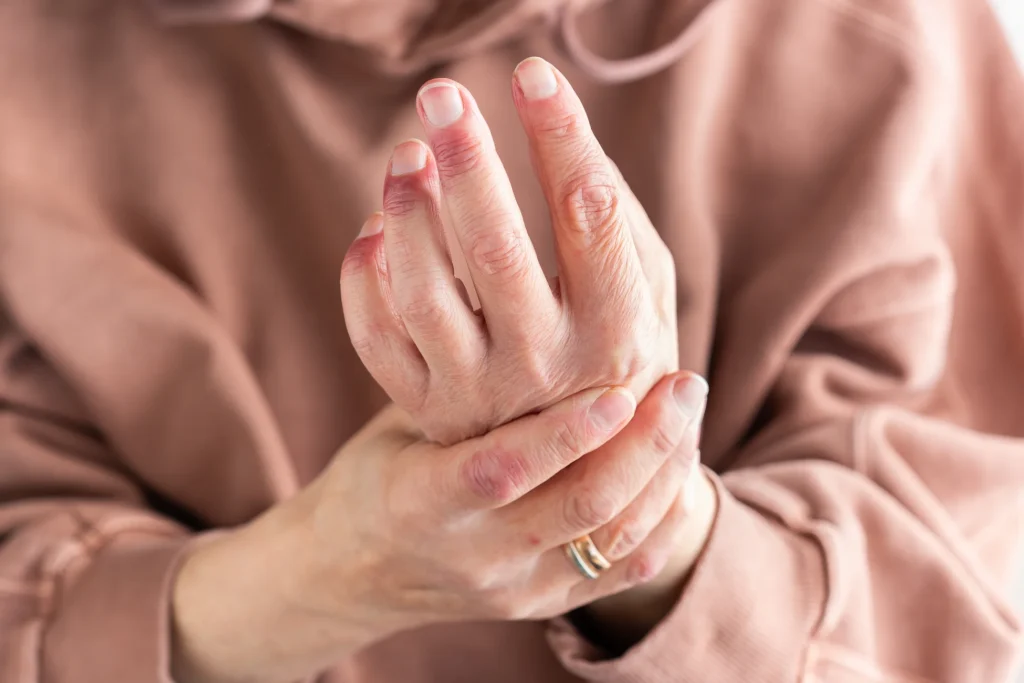 Clínica de reumatología | mano con deformidades por artrosis de manos - clinica de reumatologia